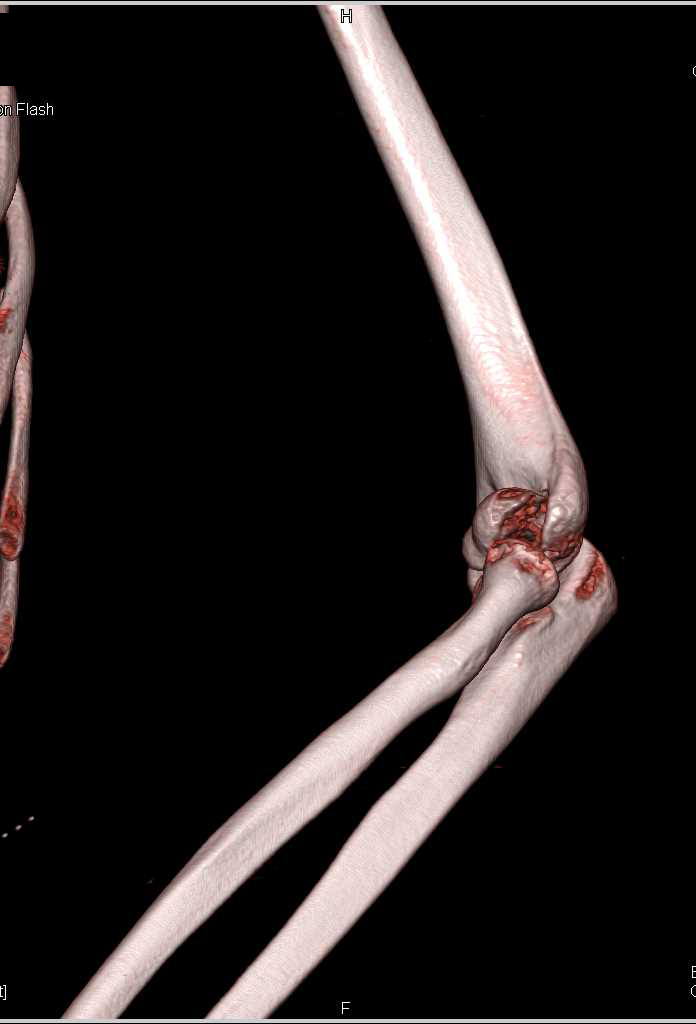 Distal Humerus Fracture - CTisus CT Scan