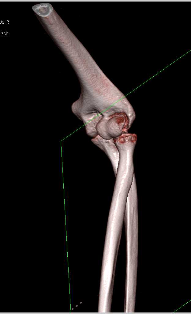 Distal Humerus Fracture - CTisus CT Scan