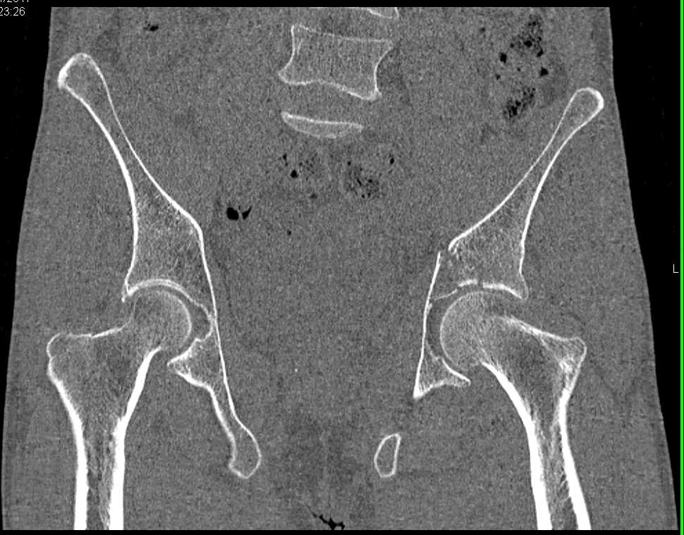 Acetabular Fracture with Automated Bone Removal - CTisus CT Scan