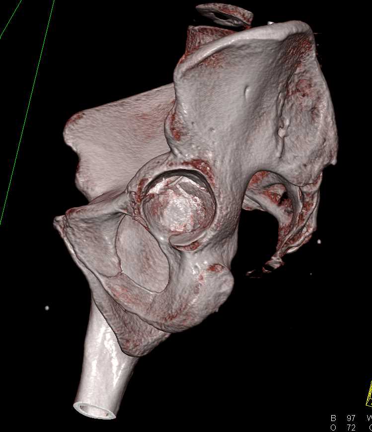 Acetabular Fracture with Automated Bone Removal - CTisus CT Scan