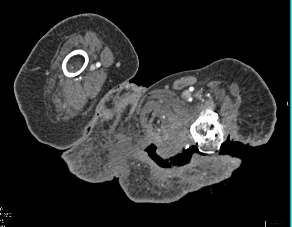 Large Decubitus Ulcer - CTisus CT Scan