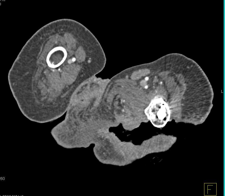 Large Decubitus Ulcer with Patent Vessels - CTisus CT Scan