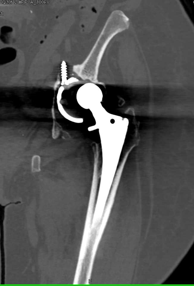 Failed Left Total Hip - CTisus CT Scan