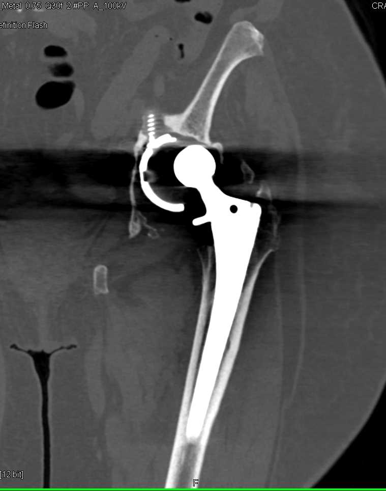 Failed Left Total Hip Replacement - CTisus CT Scan