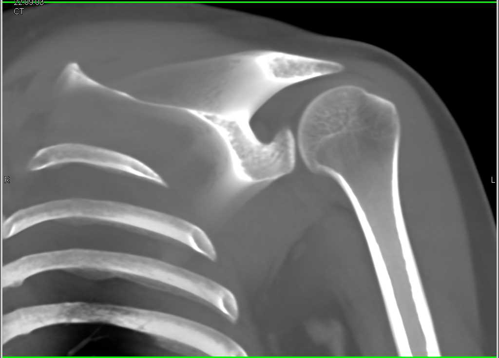 Dislocation Left Shoulder - CTisus CT Scan