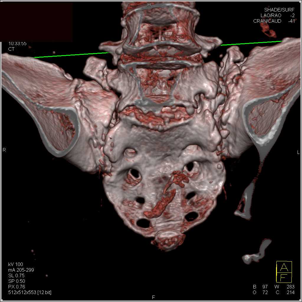 Stress Fractures in the Sacrum - CTisus CT Scan