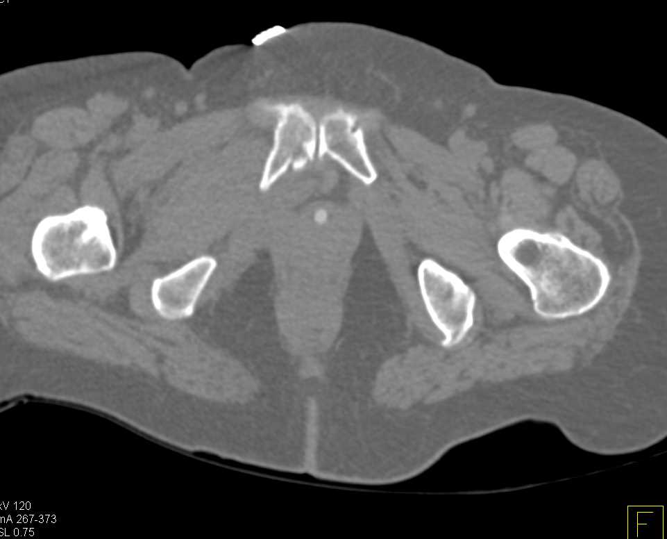 Sacral and Pelvic Fractures - CTisus CT Scan