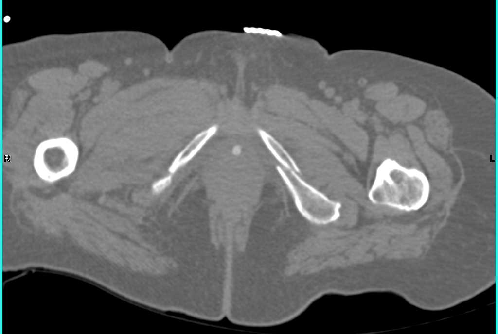 Sacral and Pelvic Fractures - CTisus CT Scan