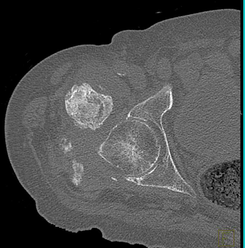 Extensive Heterotopic Calcification by the Right Hip - CTisus CT Scan