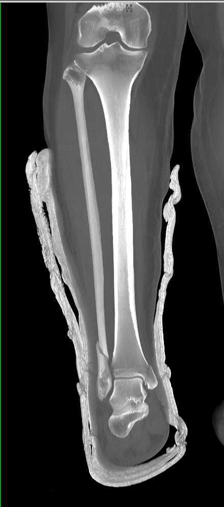 Distal Tibial and Fibular Fractures - CTisus CT Scan