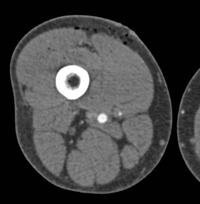 Soft Tissue Injury Thigh s/p Gunshot Wound (GSW) - CTisus CT Scan