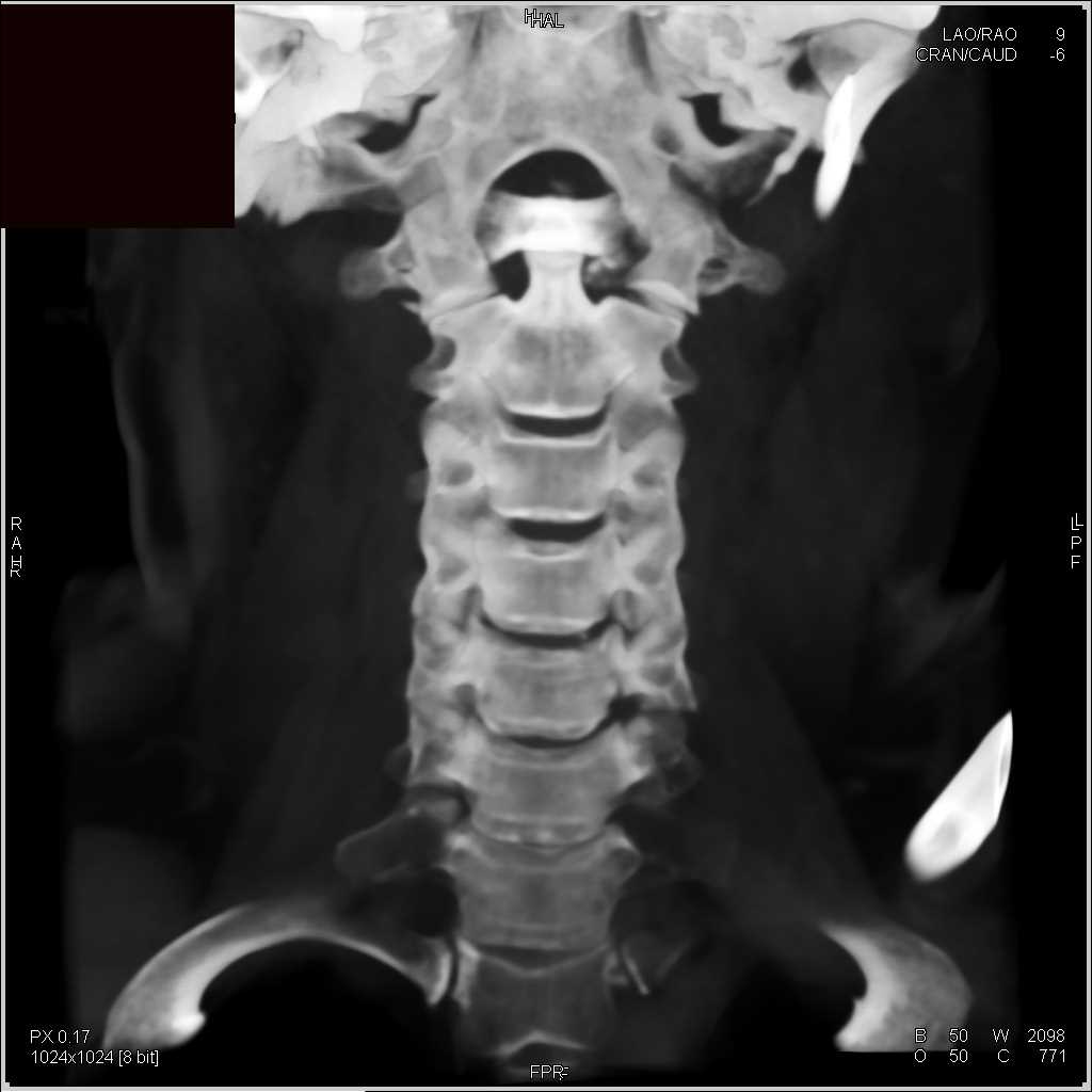 C-1 Cervical Fracture - CTisus CT Scan