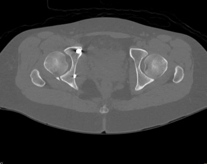 Acetabular Fracture with Repair - CTisus CT Scan