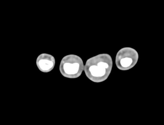 Cellulitis - CTisus CT Scan