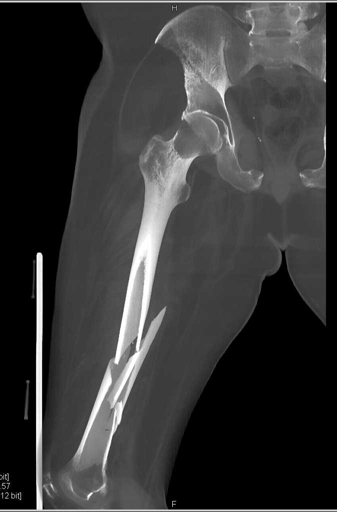 Spiral Fracture of the Femur - CTisus CT Scan