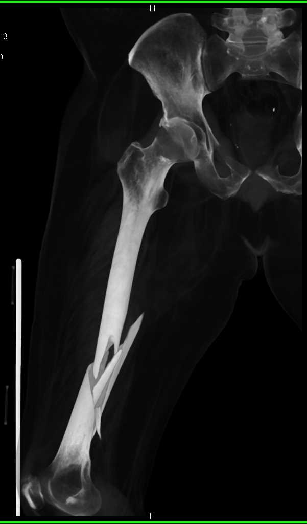 toddler-fracture-image-radiopaedia