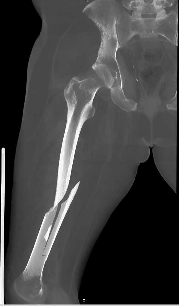 quarterback spiral fracture