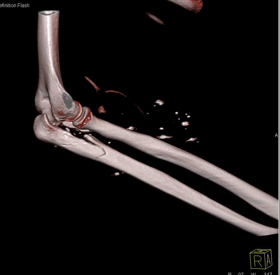 GSW with Ulnar Fracture - CTisus CT Scan