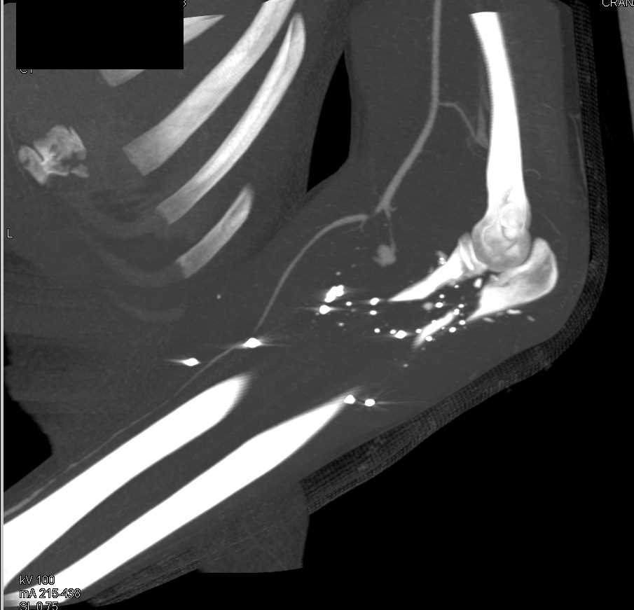 GSW with Ulnar Fracture - CTisus CT Scan