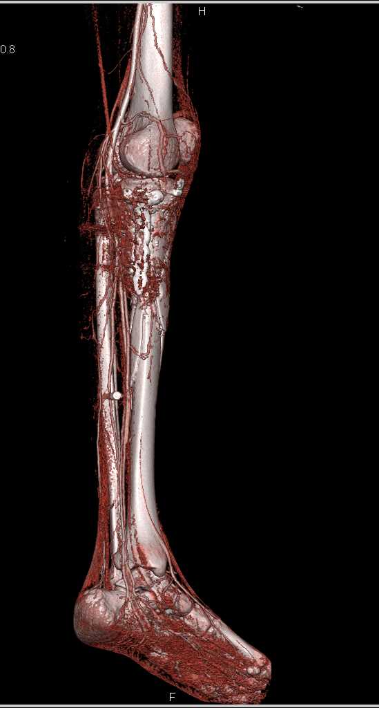 Comminuted Fracture Tibia - CTisus CT Scan