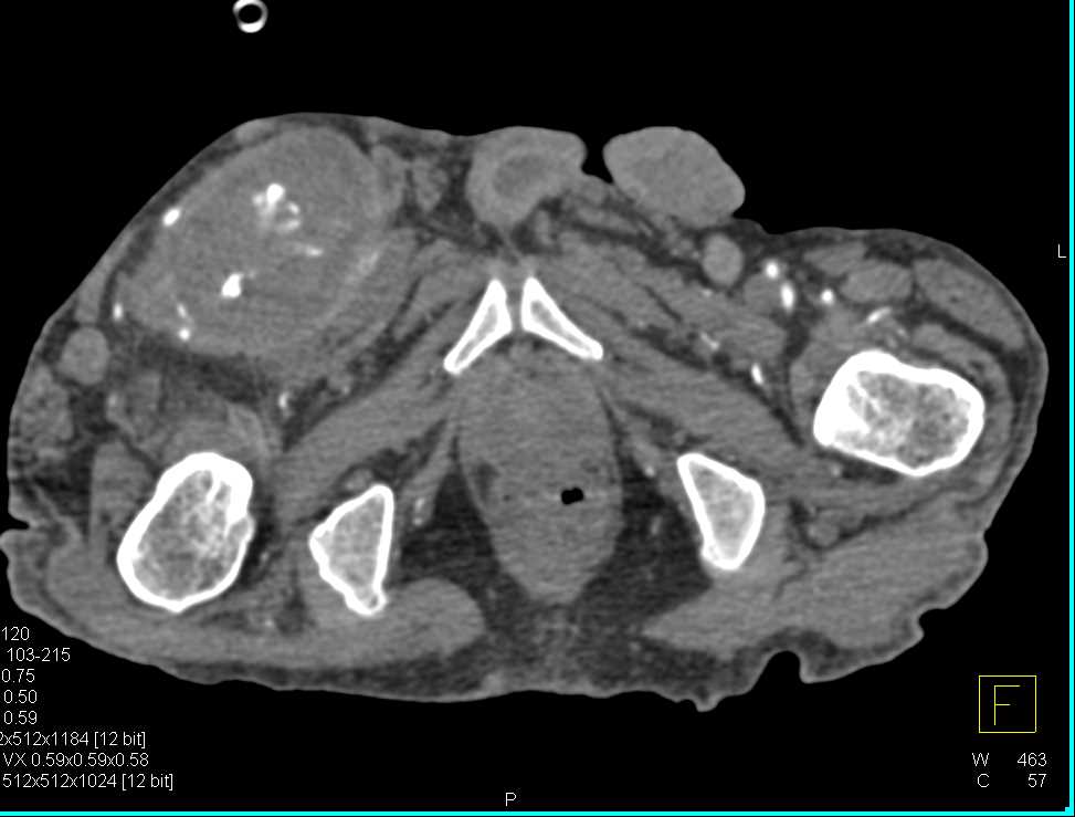 Abscess Right Groin - CTisus CT Scan