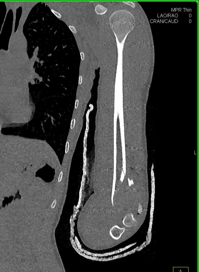 Distal Fracture of the Humerus - CTisus CT Scan