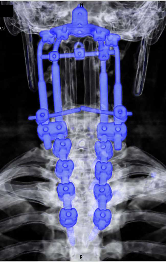 Hardware C-Spine Post Repair - CTisus CT Scan