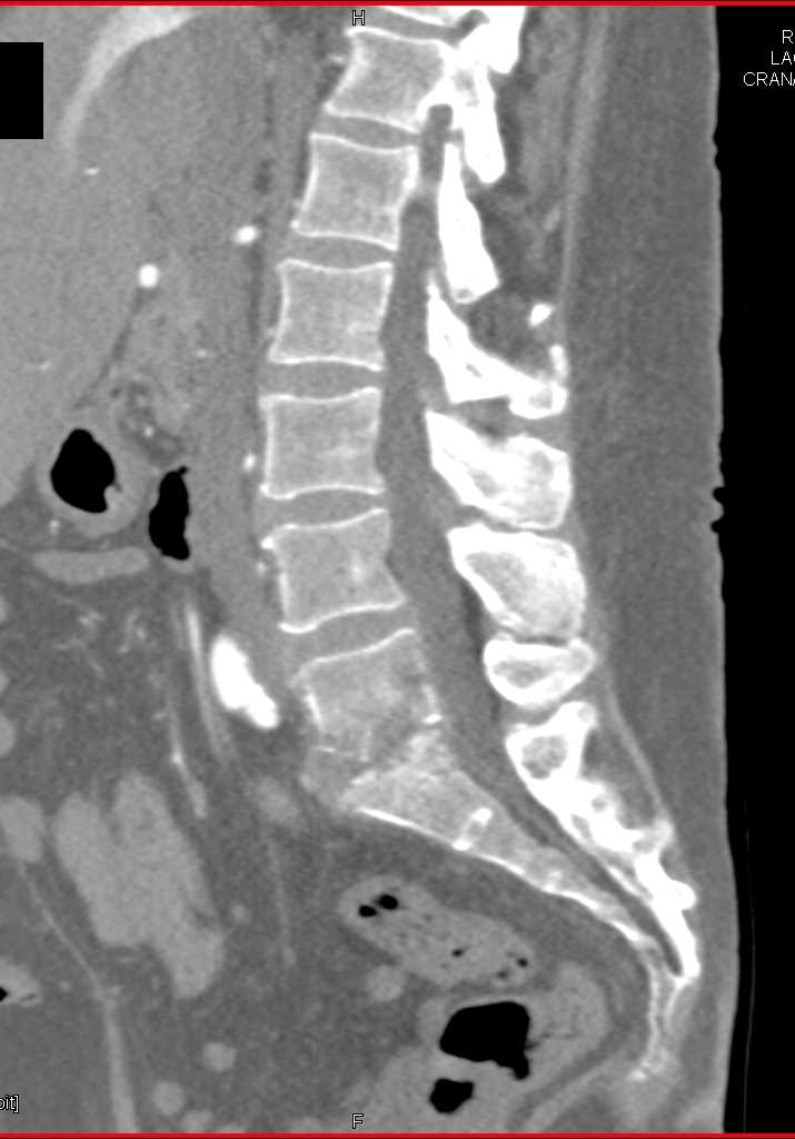 Osteomyelitis L5-S1 - CTisus CT Scan