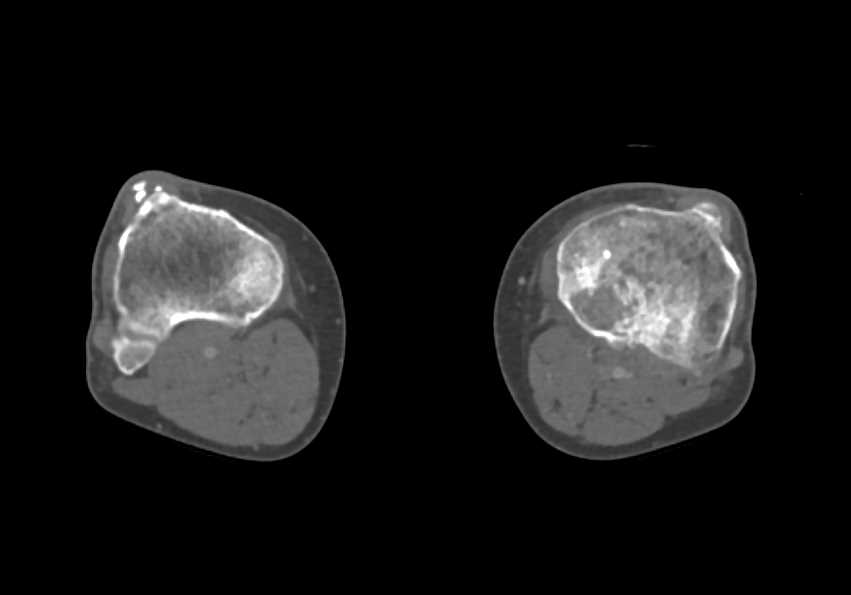 Deformity Tibial Plateau - CTisus CT Scan