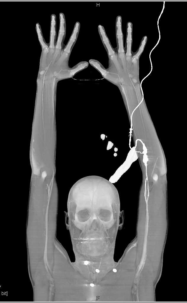 CTA of the Upper Extremity - CTisus CT Scan