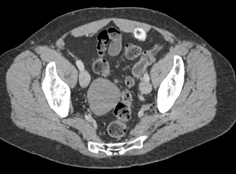 Metastases to the Left Rectus Muscle - CTisus CT Scan