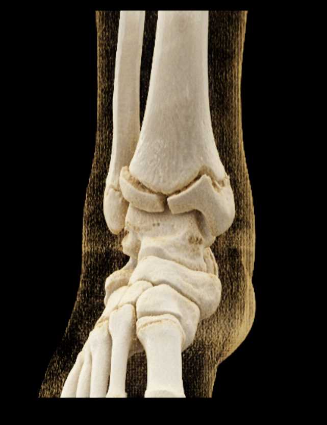 Tibial Fracture with Multiple Renderings - CTisus CT Scan