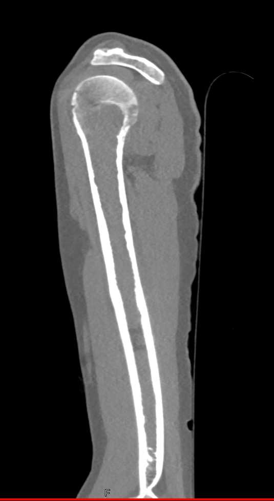 Multiple Myeloma - CTisus CT Scan