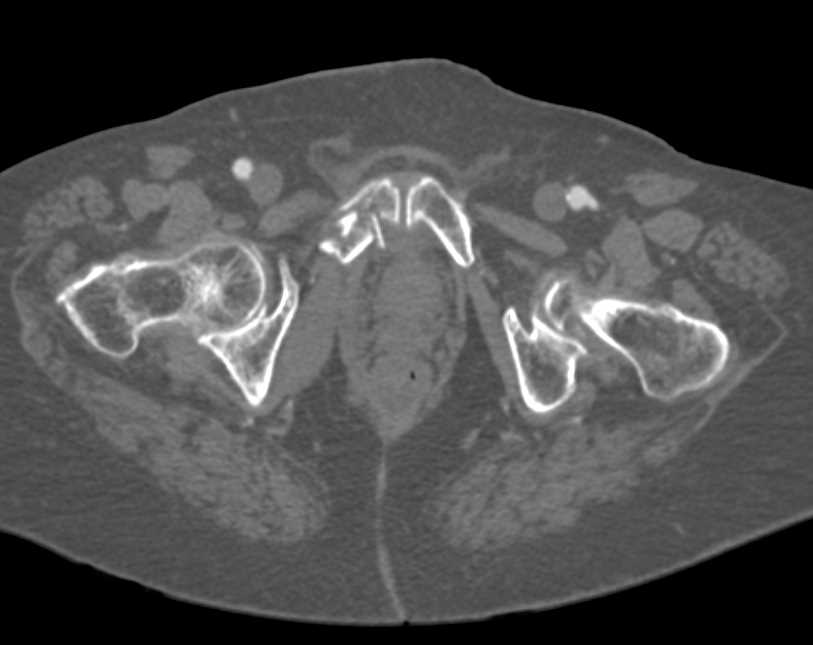 pelvic-fractures-georgia