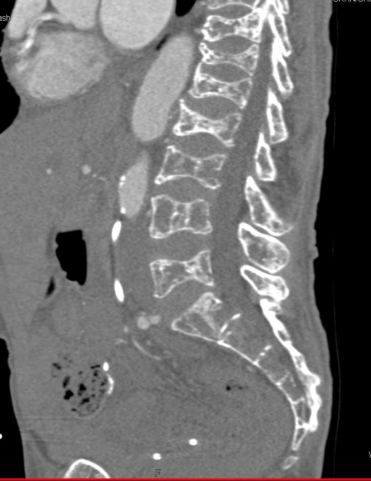 Multiple Myeloma Spine - CTisus CT Scan