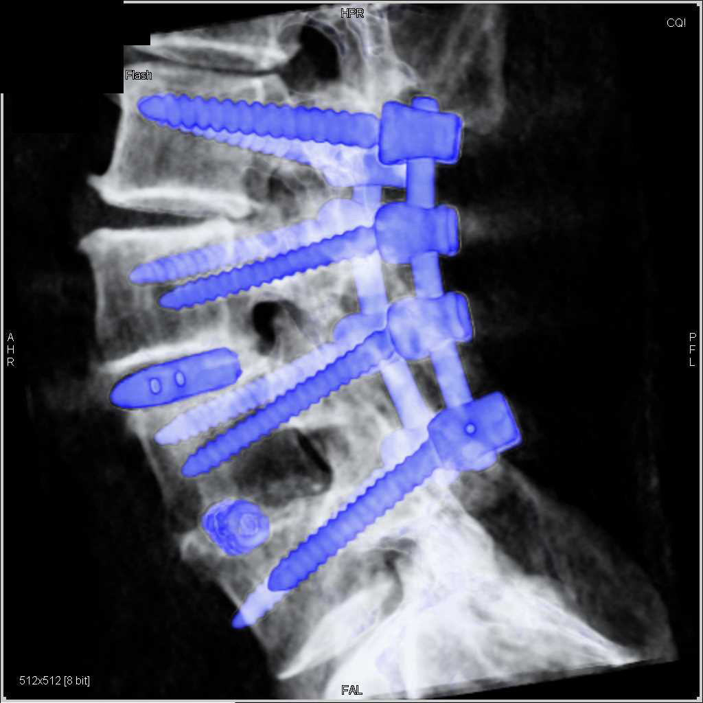 Hardware in Lumbar Spine - CTisus CT Scan