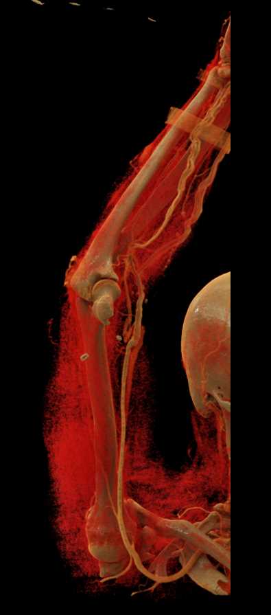 CTA of the Upper Extremity with Cinematic Rendering - CTisus CT Scan