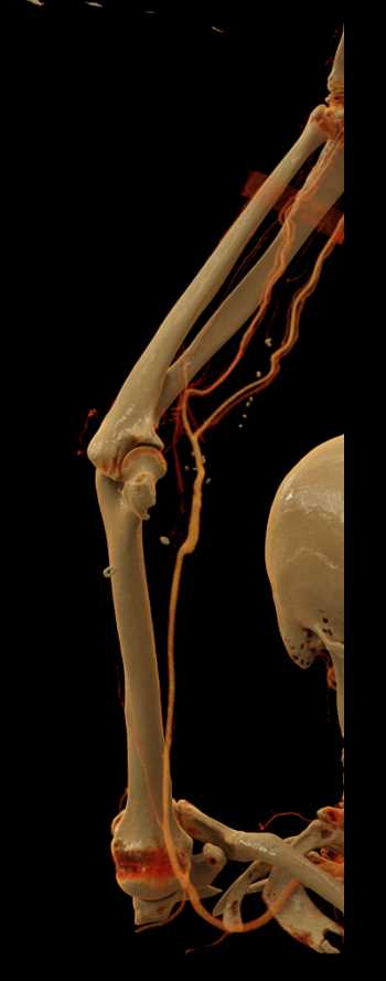 CTA of the Upper Extremity with Cinematic Rendering - CTisus CT Scan