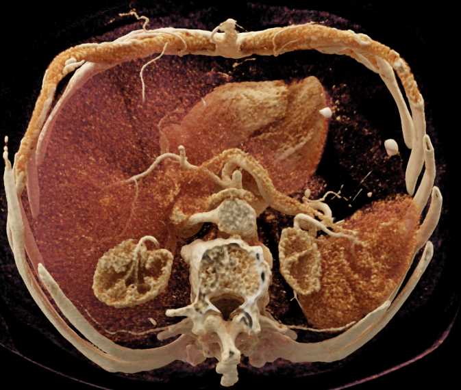 Adenocarcinoma of the Head of the Pancreas with Cinematic Rendering - CTisus CT Scan