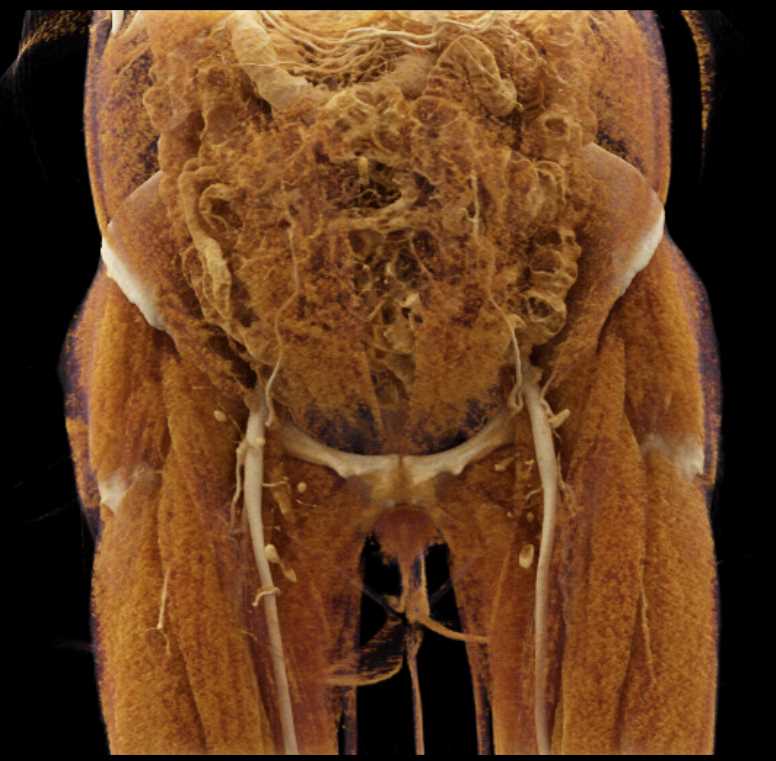 Diastasis of the Rectus Muscle with Cinematic Rendering - CTisus CT Scan