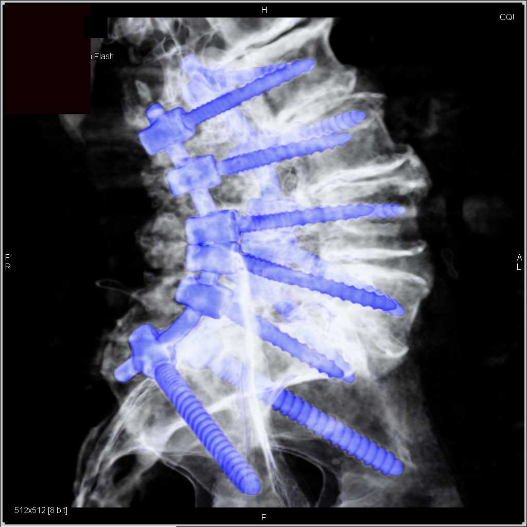 Hardware in the L-Spine - CTisus CT Scan