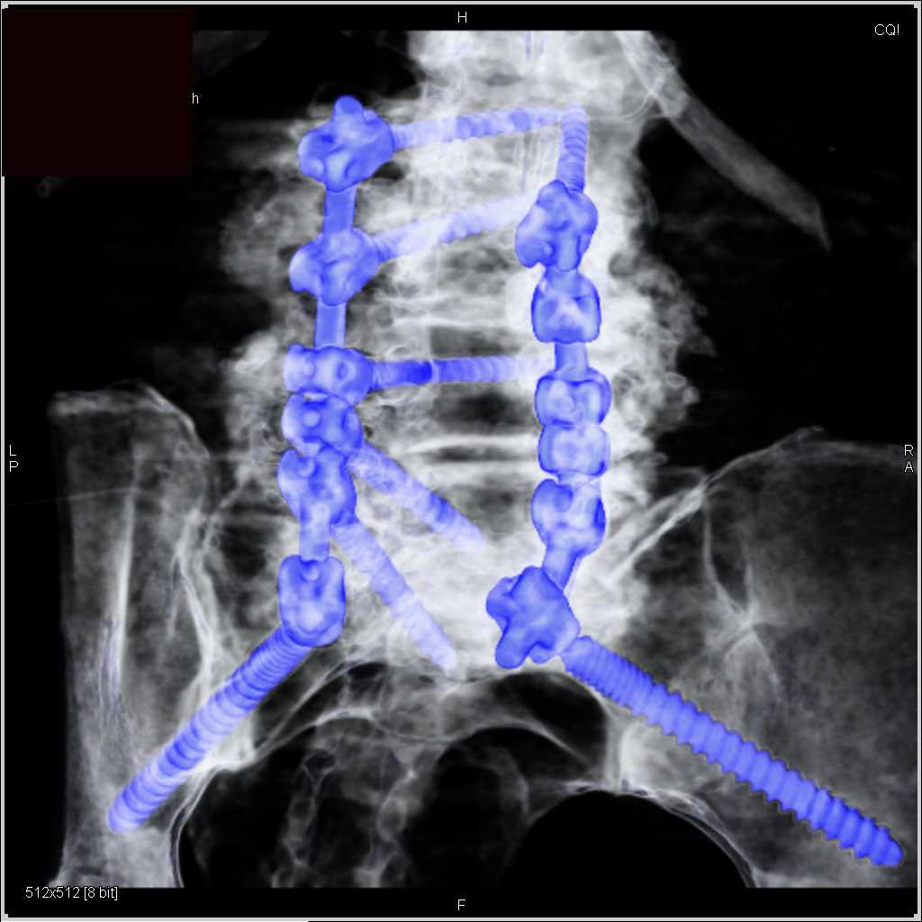Hardware in the L-Spine - CTisus CT Scan