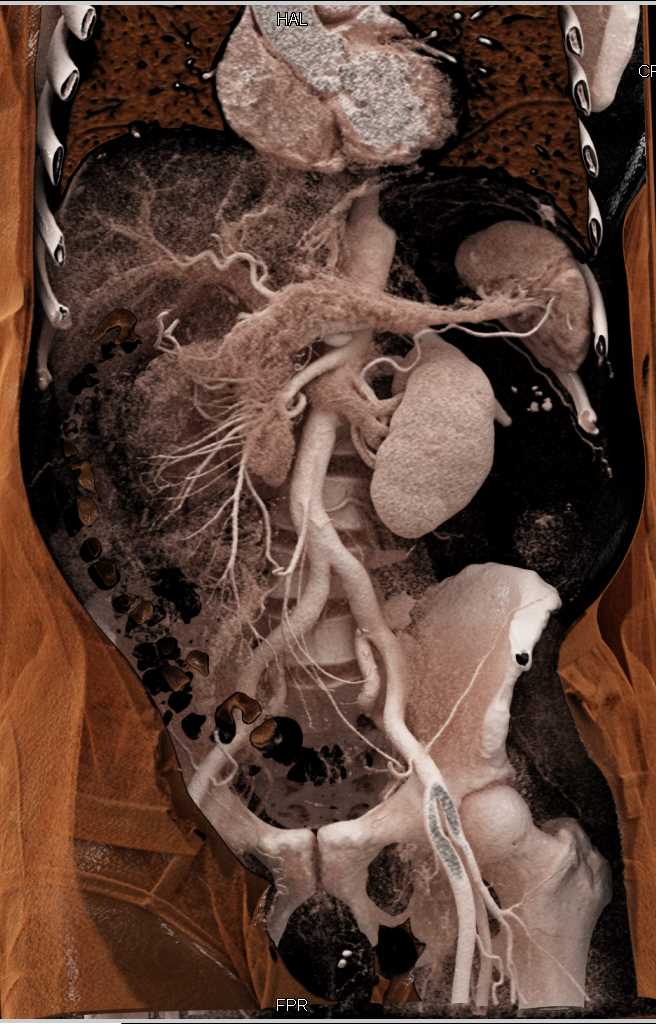 Detailed Vascular and Muscle Mapping with Cinematic Rendering - CTisus CT Scan