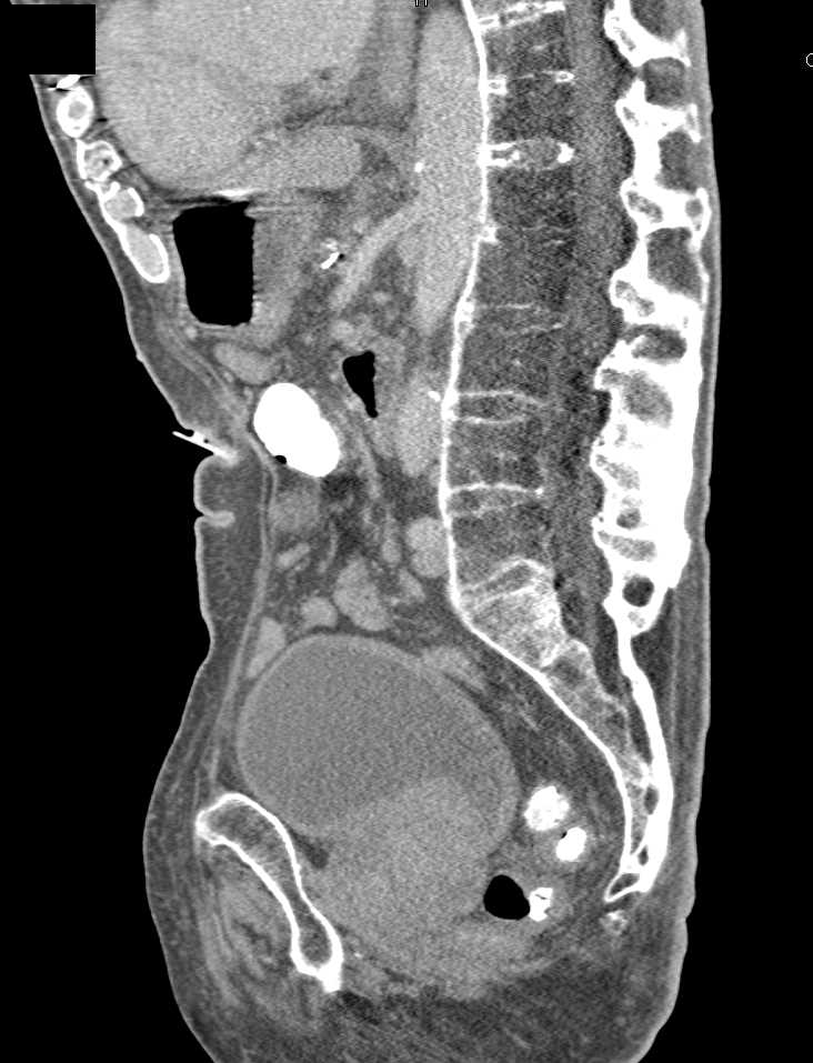 Ankylosing Spondylitis - CTisus CT Scan