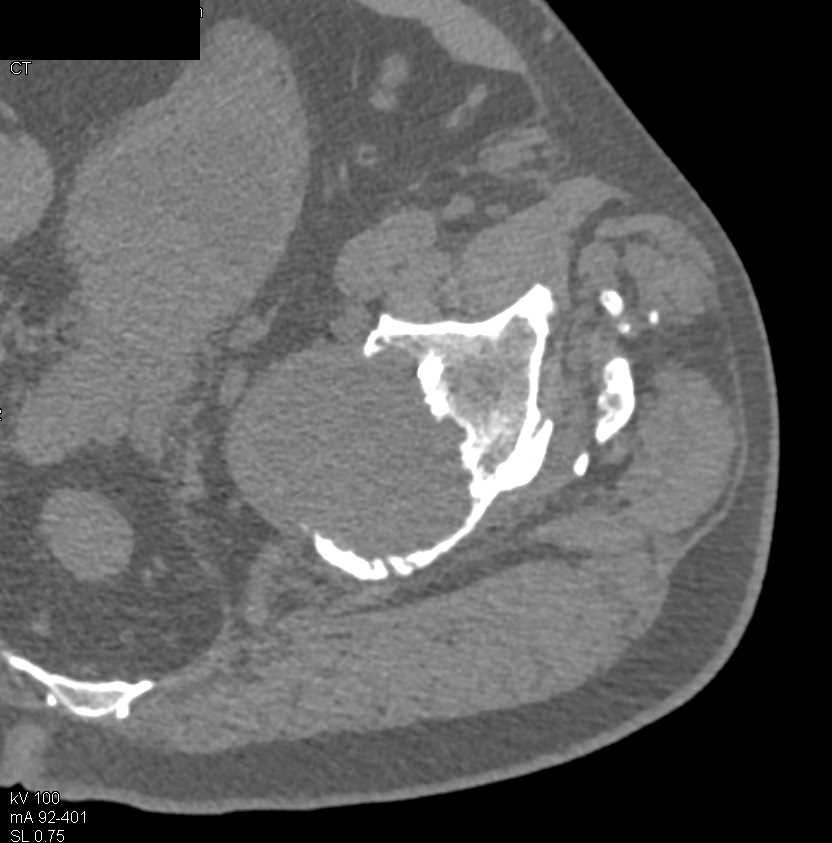 Osteolytic lesions are common radiological findings behind acetabular cups in total hip arthroplasties - CTisus CT Scan