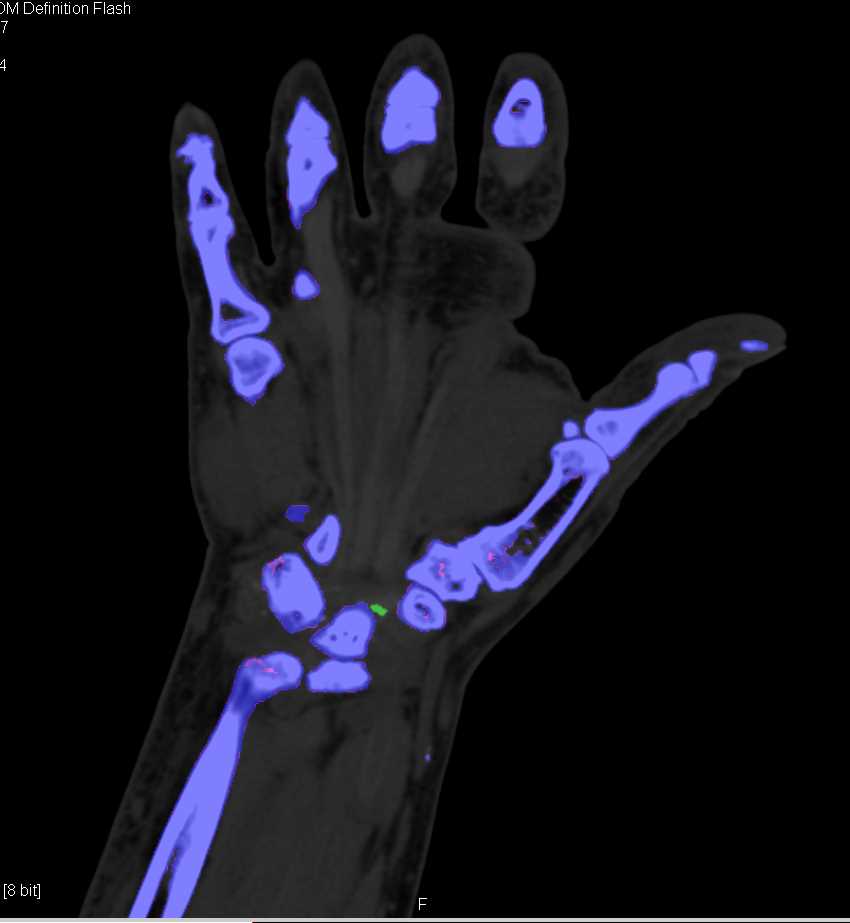 Gout - CTisus CT Scan