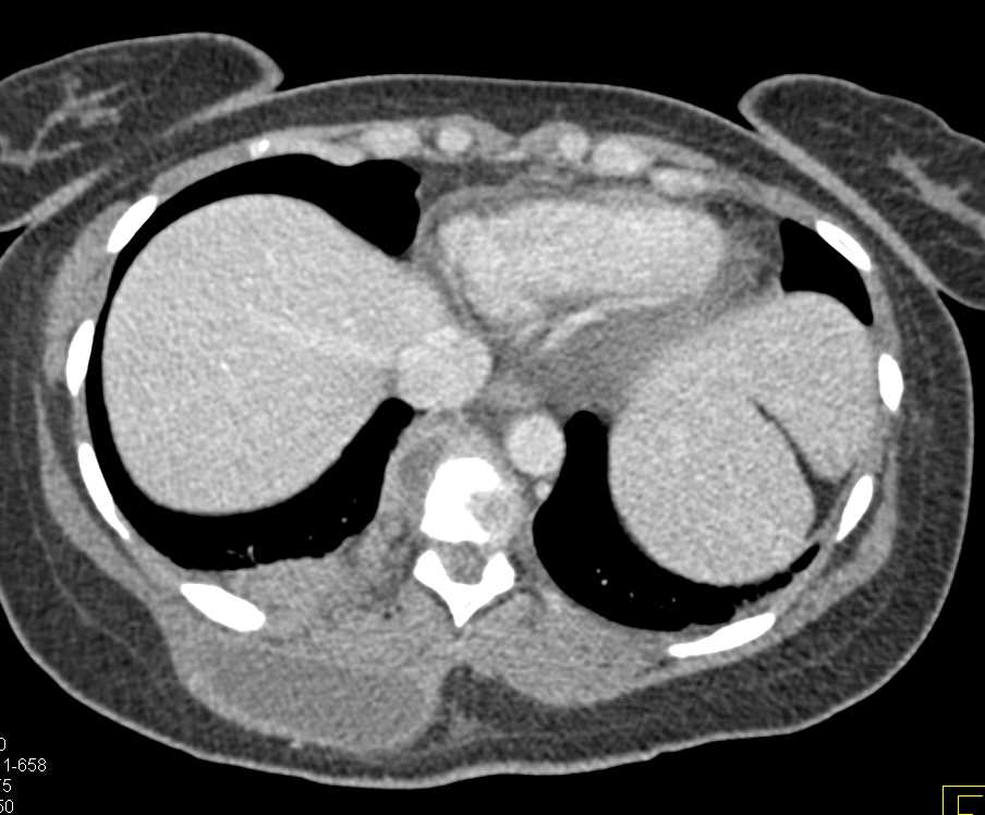 Abscess Involving Psoas and Paraspinal Muscles - CTisus CT Scan