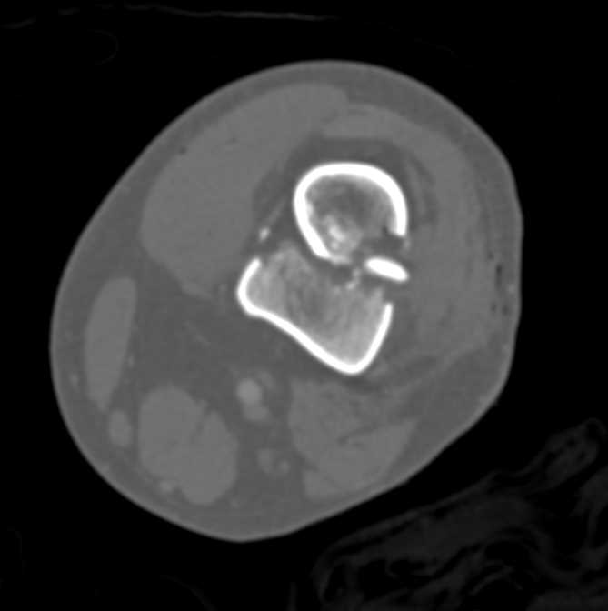 Comminuted Femur Fracture - CTisus CT Scan