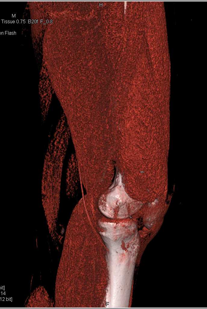 Comminuted Femur Fracture Without Vascular Injury - CTisus CT Scan