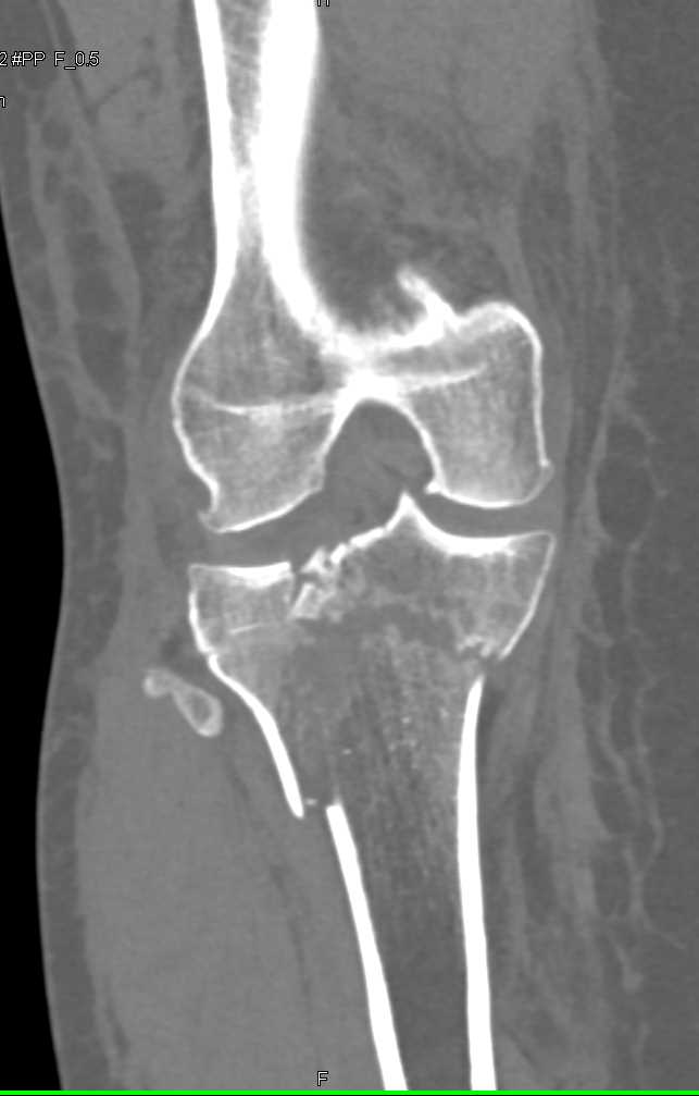Tibial Plateau and Fibular Fractures - CTisus CT Scan